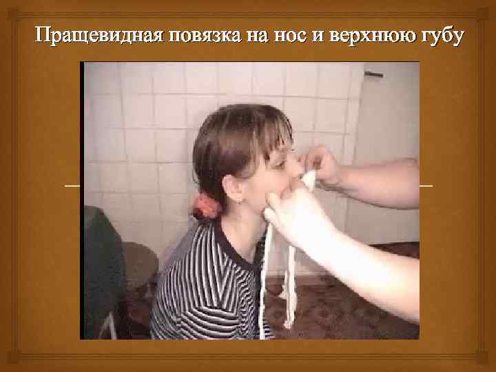Пращевидная повязка на нос и верхнюю губу 