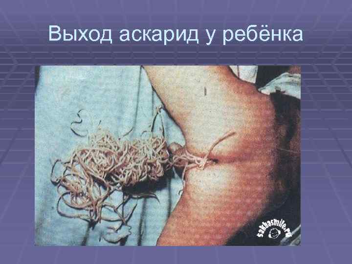 Выход аскарид у ребёнка 