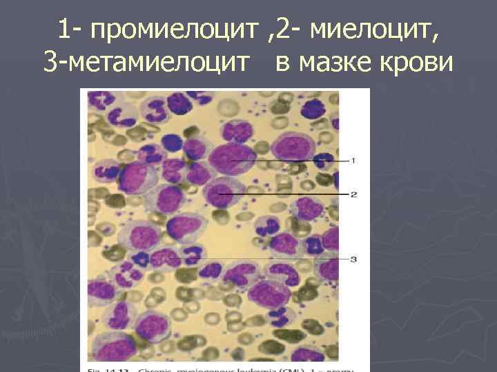 1 - промиелоцит , 2 - миелоцит, 3 -метамиелоцит в мазке крови 
