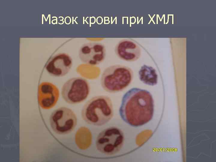 Мазок крови при ХМЛ 