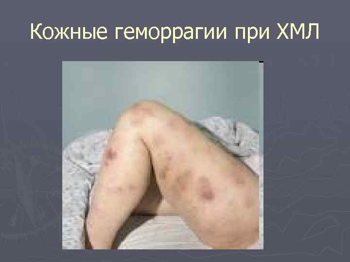 Кожные геморрагии при ХМЛ 