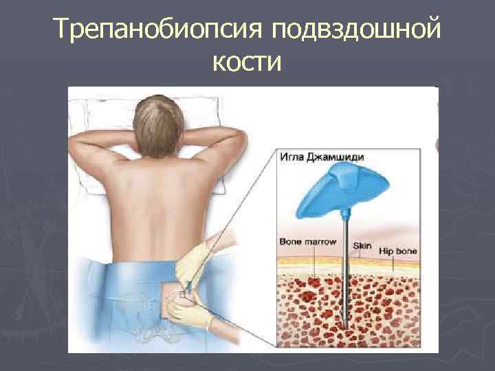 Трепанобиопсия подвздошной кости 