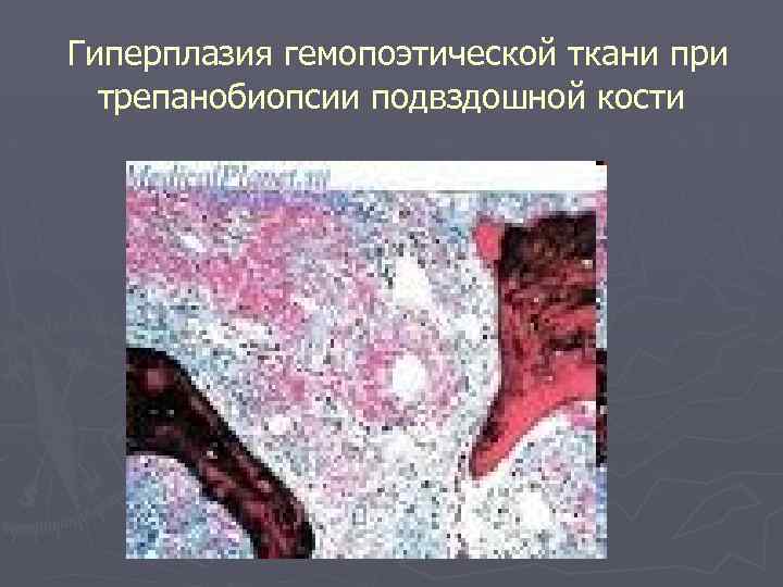 Гиперплазия гемопоэтической ткани при трепанобиопсии подвздошной кости 