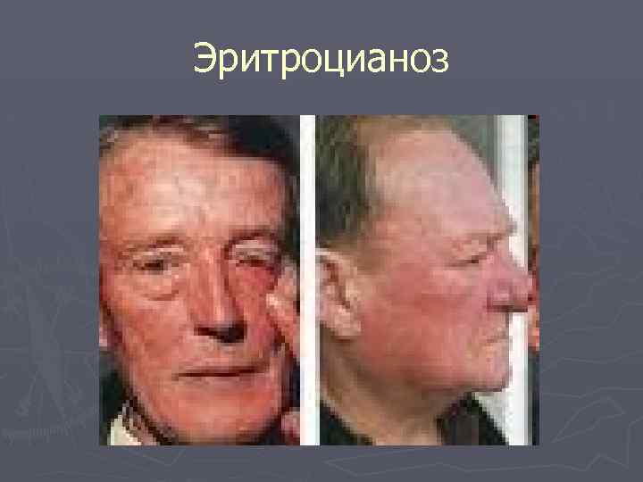 Эритроцианоз 