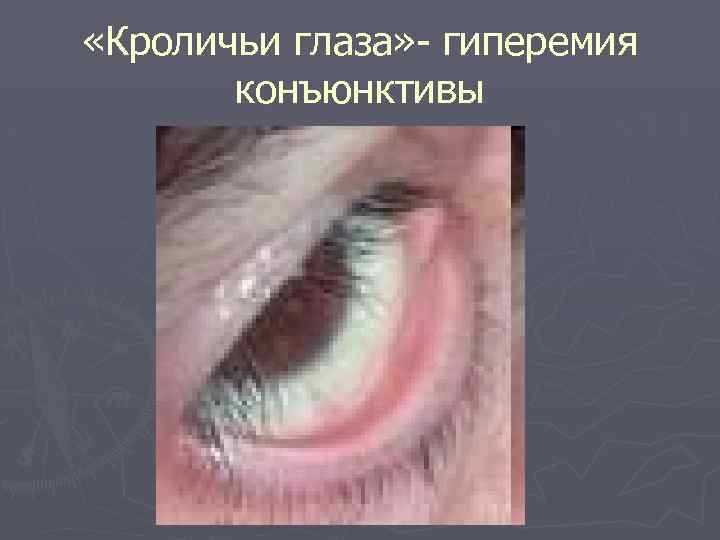  «Кроличьи глаза» - гиперемия конъюнктивы 