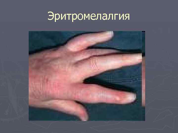 Эритромелалгия 