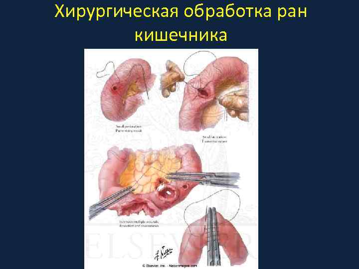 Хирургическая обработка ран кишечника 