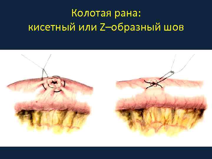 Колотая рана: кисетный или Z–образный шов 