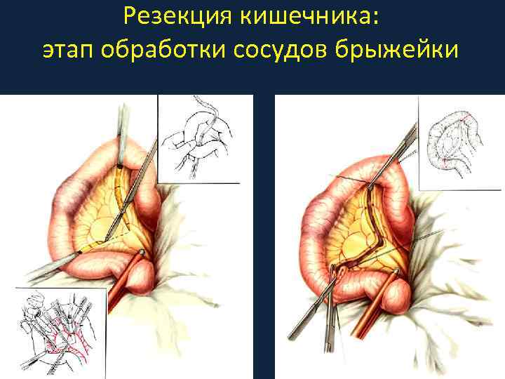 Резекция кишечника: этап обработки сосудов брыжейки 