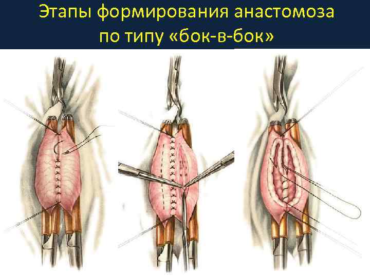 Этапы формирования анастомоза по типу «бок-в-бок» 