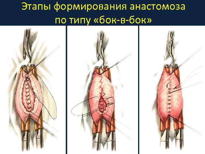 Этапы формирования анастомоза по типу «бок-в-бок» 