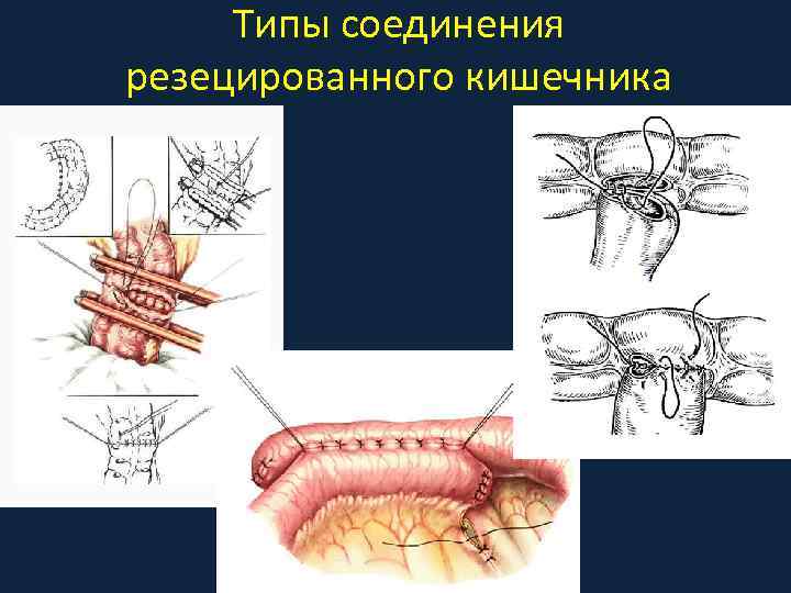 Типы соединения резецированного кишечника 