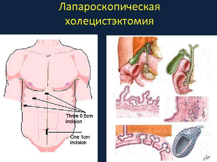 Лапароскопическая холецистэктомия 