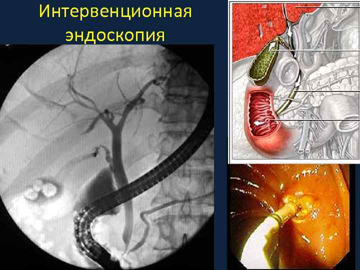 Интервенционная эндоскопия 