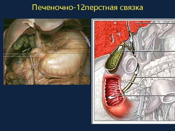 Печеночно-12 перстная связка 