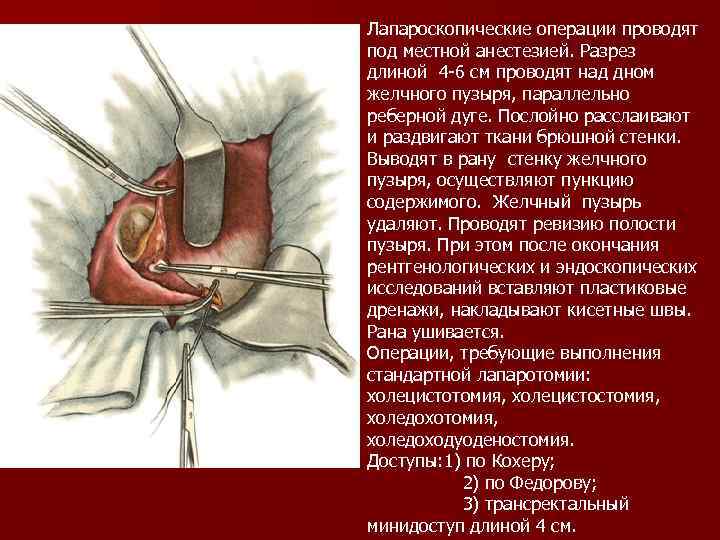 Лапароскопические операции проводят под местной анестезией. Разрез длиной 4 -6 см проводят над дном