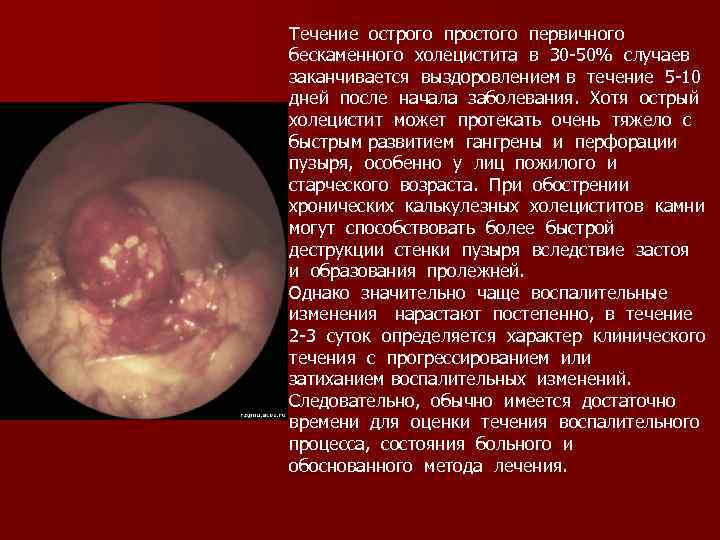Течение острого простого первичного бескаменного холецистита в 30 -50% случаев заканчивается выздоровлением в течение