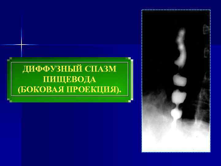 ДИФФУЗНЫЙ СПАЗМ ПИЩЕВОДА (БОКОВАЯ ПРОЕКЦИЯ). 