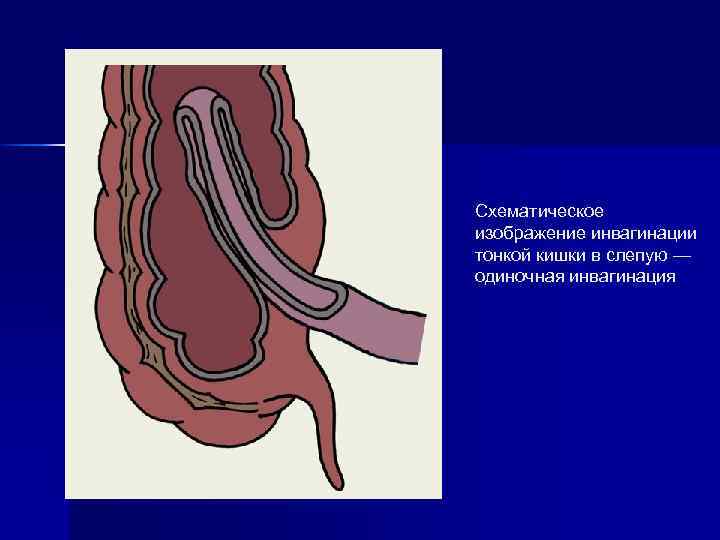 Схематическое изображение инвагинации тонкой кишки в слепую — одиночная инвагинация 
