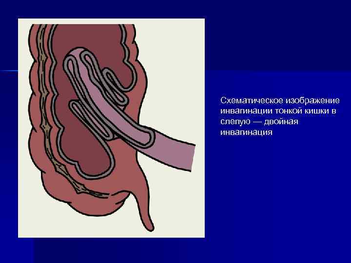 Схематическое изображение инвагинации тонкой кишки в слепую — двойная инвагинация 