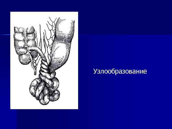 Узлообразование 