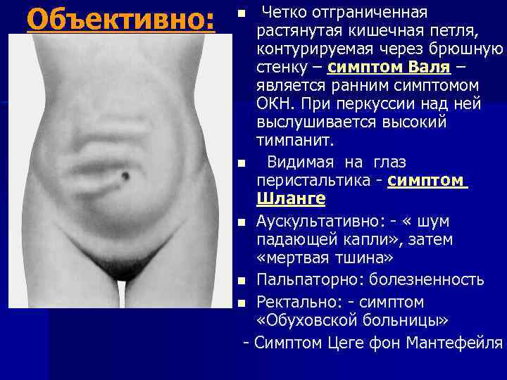 Объективно: Четко отграниченная растянутая кишечная петля, контурируемая через брюшную стенку – симптом Валя –