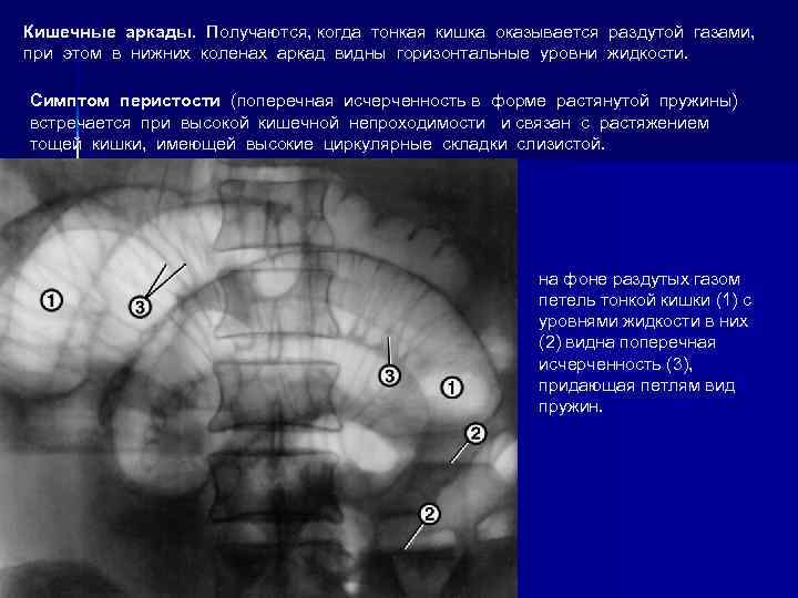 Кишечные аркады. Получаются, когда тонкая кишка оказывается раздутой газами, при этом в нижних коленах