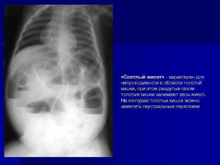  «Светлый живот» - характерен для непроходимости в области толстой кишки, при этом раздутые