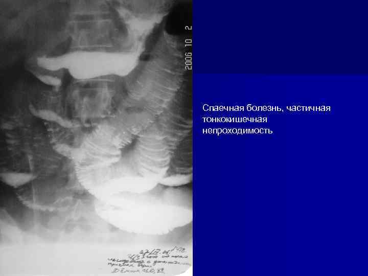 Спаечная болезнь, частичная тонкокишечная непроходимость 