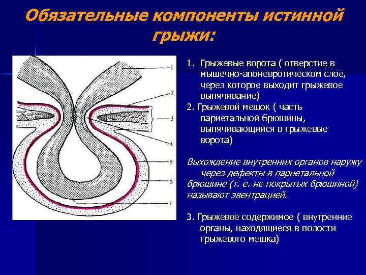 Грыжевой мешок. Элементы грыжевого мешка. Строение грыжевого мешка. Компоненты истинной грыжи. Составные элементы грыжи.