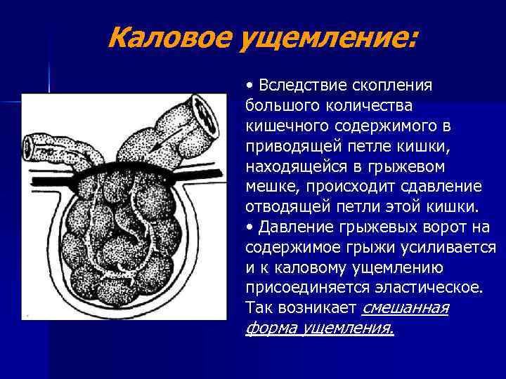 Каловое ущемление: • Вследствие скопления большого количества кишечного содержимого в приводящей петле кишки, находящейся