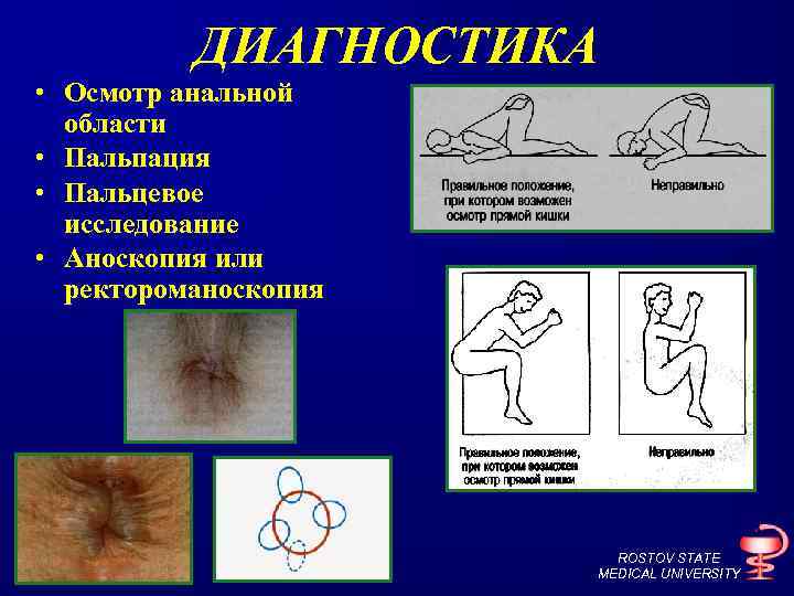ДИАГНОСТИКА • Осмотр анальной области • Пальпация • Пальцевое исследование • Аноскопия или ректороманоскопия