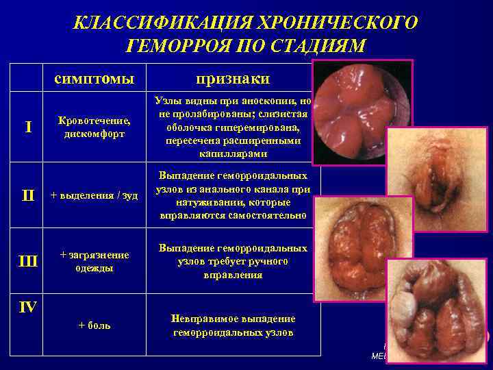 КЛАССИФИКАЦИЯ ХРОНИЧЕСКОГО ГЕМОРРОЯ ПО СТАДИЯМ симптомы признаки Кровотечение, дискомфорт Узлы видны при аноскопии, но