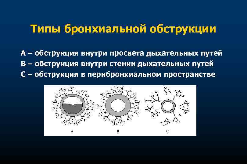 Типы бронхиальной обструкции А – обструкция внутри просвета дыхательных путей В – обструкция внутри