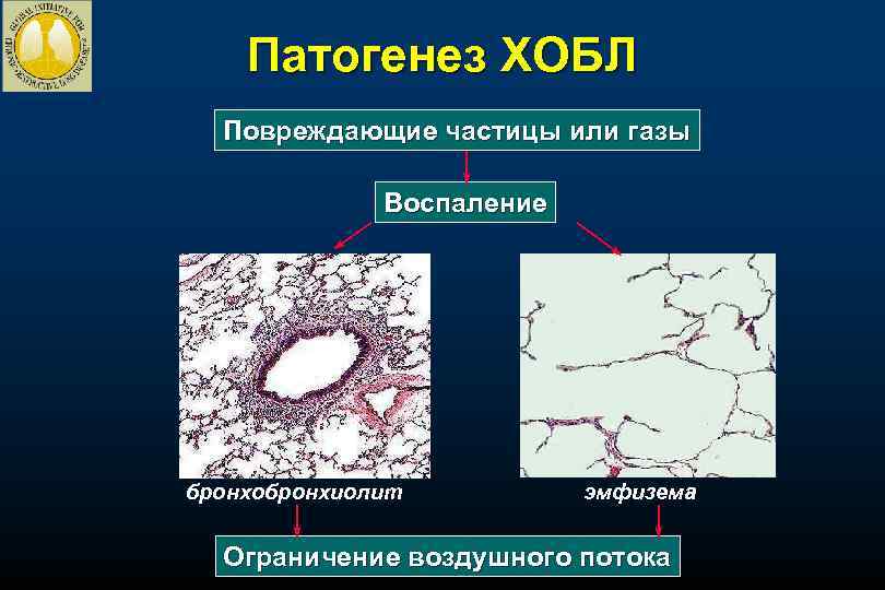 Патогенез ХОБЛ Повреждающие частицы или газы Воспаление бронхобронхиолит эмфизема Ограничение воздушного потока 