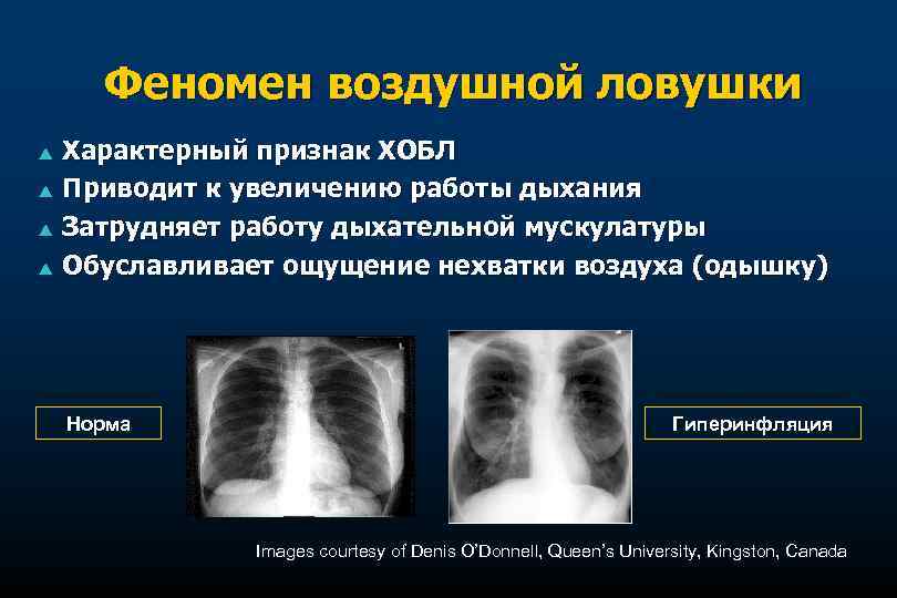 Феномен воздушной ловушки p p Характерный признак ХОБЛ Приводит к увеличению работы дыхания Затрудняет