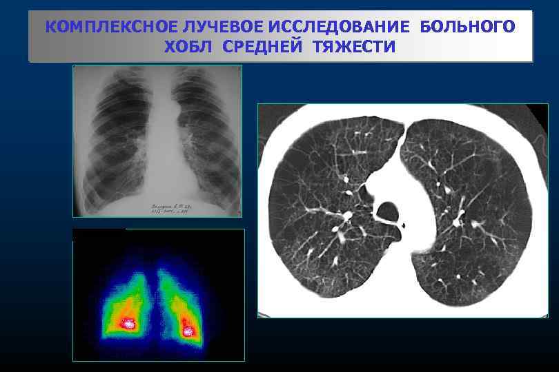 КОМПЛЕКСНОЕ ЛУЧЕВОЕ ИССЛЕДОВАНИЕ БОЛЬНОГО ХОБЛ СРЕДНЕЙ ТЯЖЕСТИ 