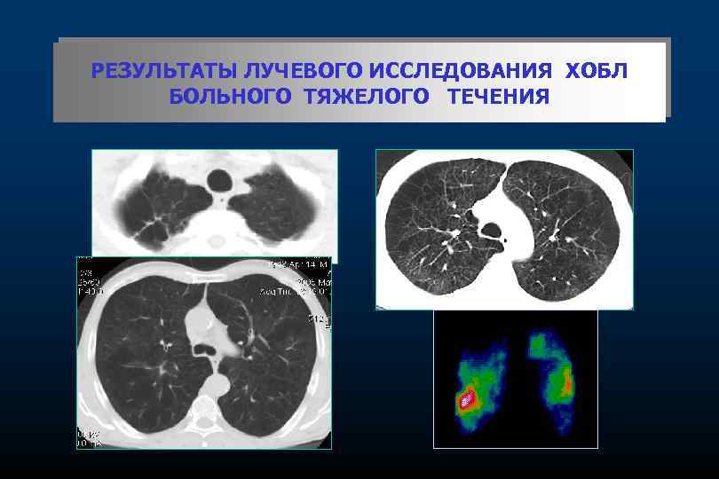 РЕЗУЛЬТАТЫ ЛУЧЕВОГО ИССЛЕДОВАНИЯ ХОБЛ БОЛЬНОГО ТЯЖЕЛОГО ТЕЧЕНИЯ 