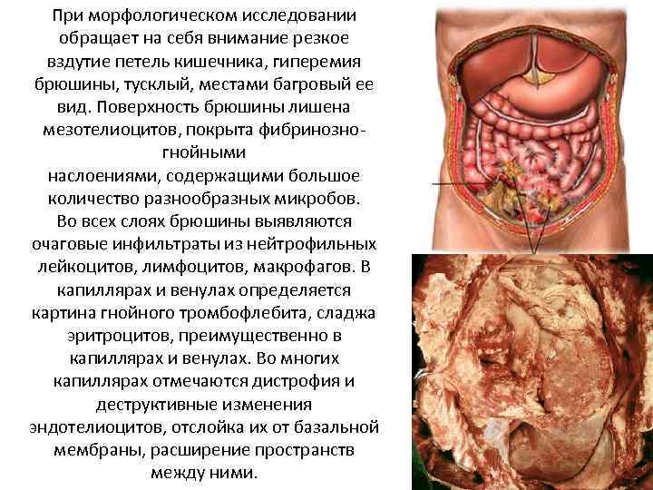 При морфологическом исследовании обращает на себя внимание резкое вздутие петель кишечника, гиперемия брюшины, тусклый,