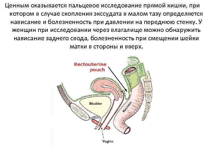 Ценным оказывается пальцевое исследование прямой кишки, при котором в случае скопления экссудата в малом