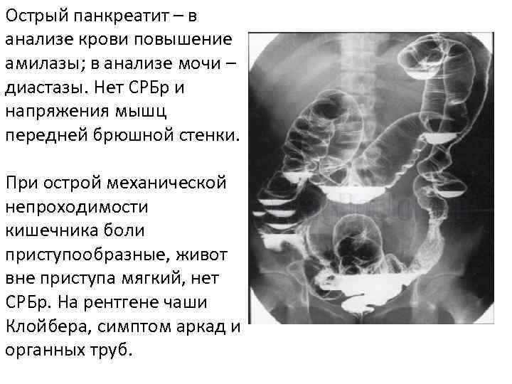 Острый панкреатит – в анализе крови повышение амилазы; в анализе мочи – диастазы. Нет