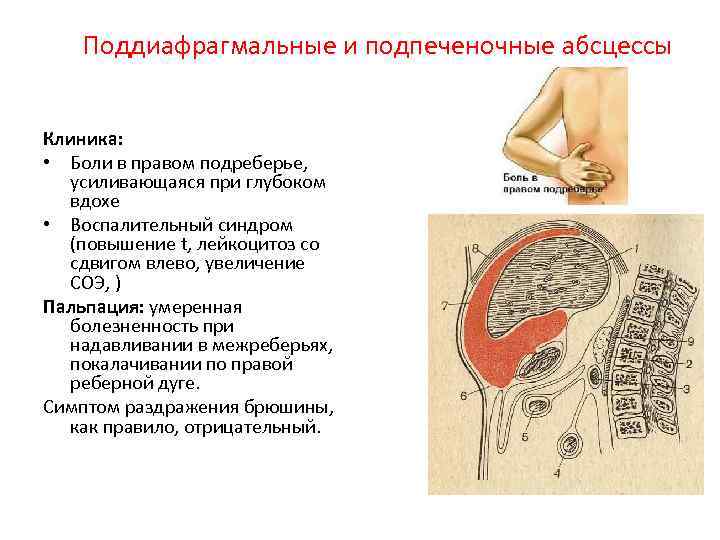 Поддиафрагмальные и подпеченочные абсцессы Клиника: • Боли в правом подреберье, усиливающаяся при глубоком вдохе