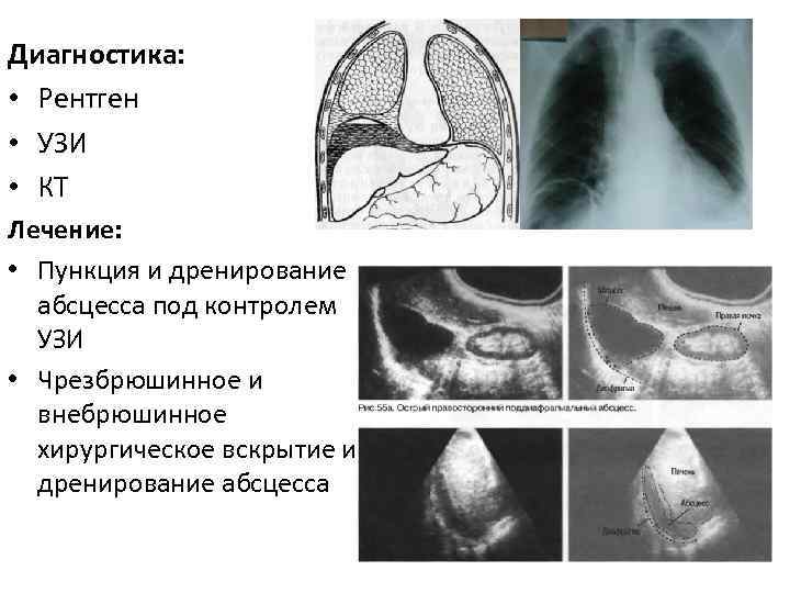 Диагностика: • Рентген • УЗИ • КТ Лечение: • Пункция и дренирование абсцесса под