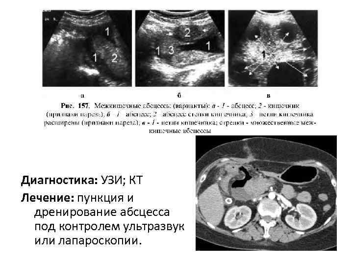 Диагностика: УЗИ; КТ Лечение: пункция и дренирование абсцесса под контролем ультразвук или лапароскопии. 