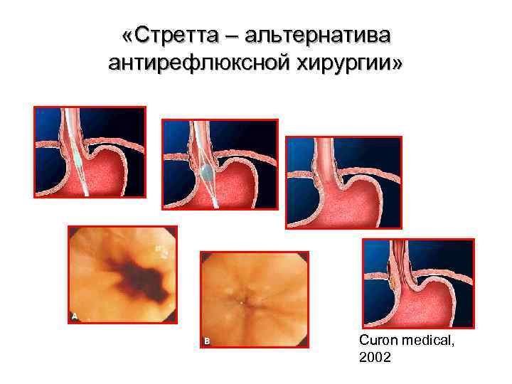  «Стретта – альтернатива антирефлюксной хирургии» Curon medical, 2002 