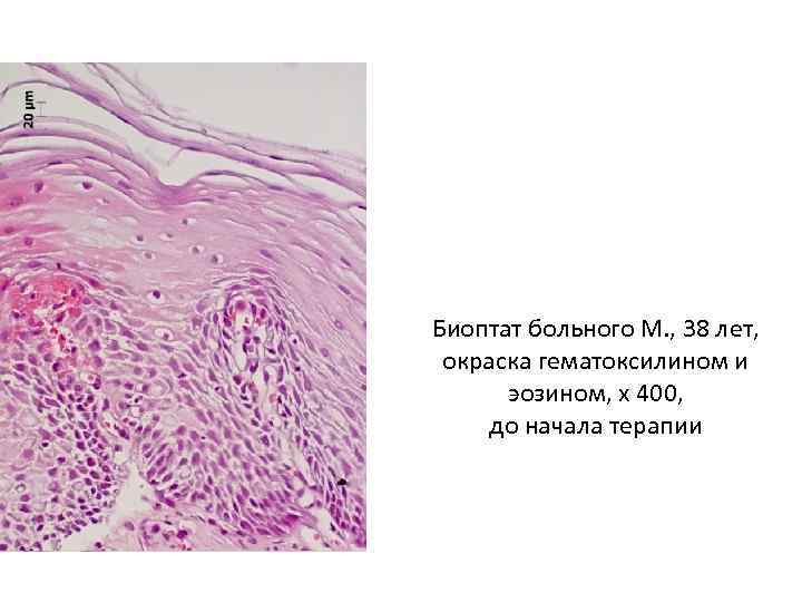 Биоптат больного М. , 38 лет, окраска гематоксилином и эозином, х 400, до начала