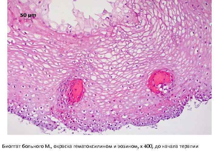 Биоптат больного М. , окраска гематоксилином и эозином, х 400, до начала терапии 