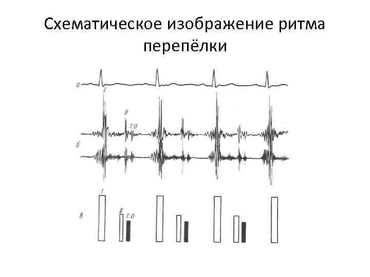 Схематическое изображение ритма перепёлки 