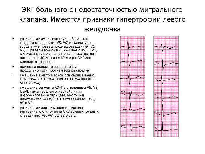 ЭКГ больного с недостаточностью митрального клапана. Имеются признаки гипертрофии левого желудочка • • •