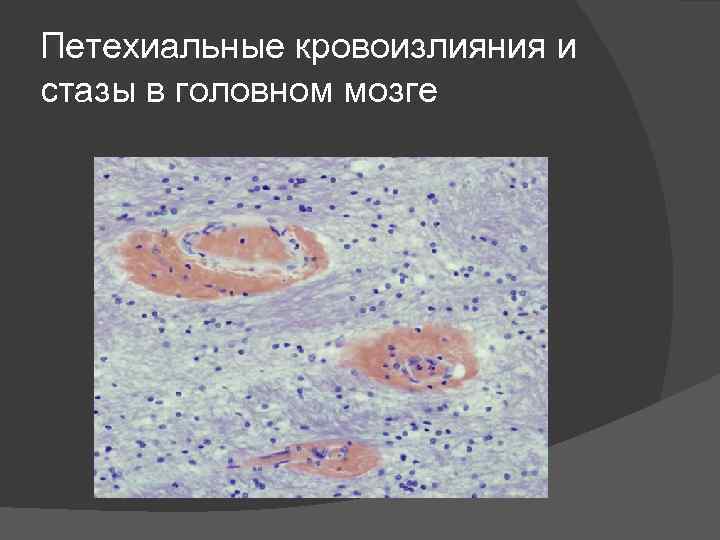 Петехиальные кровоизлияния и стазы в головном мозге 